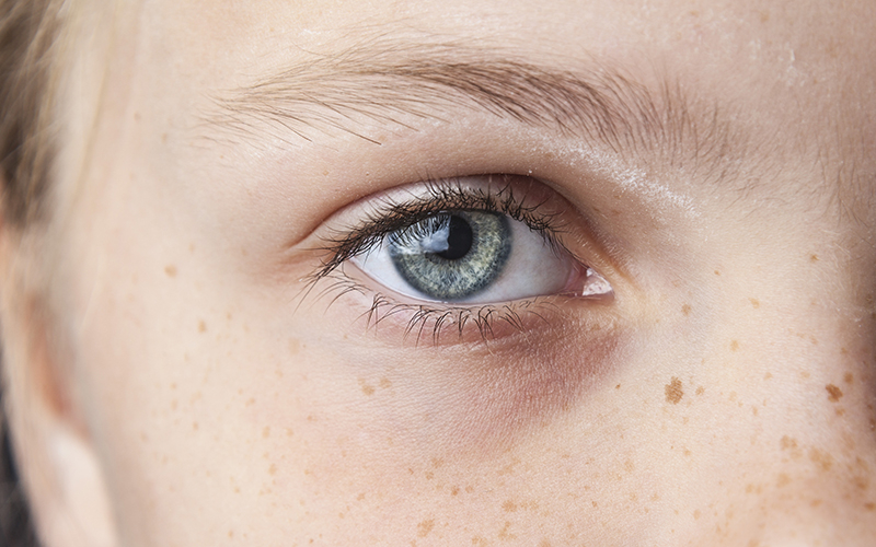 «Умный» скрининг помог выявить диабетическую ретинопатию у детей