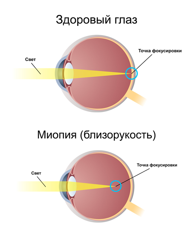 Заболевания глаукомой при близорукости