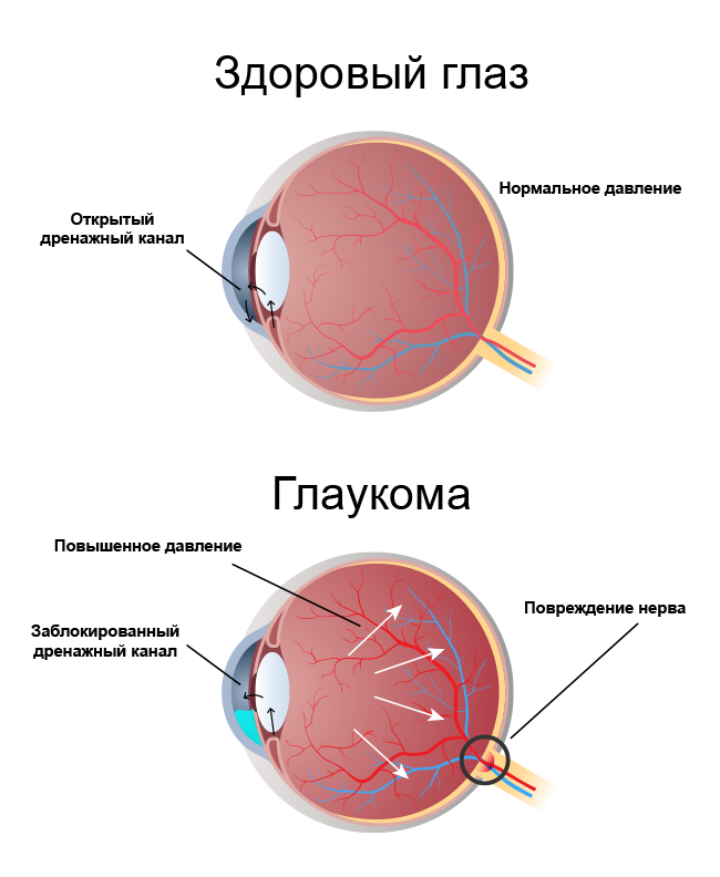 Изменение цвета глаза при глаукоме