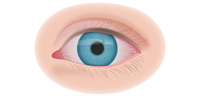 Лечение синдрома “сухого глаза”