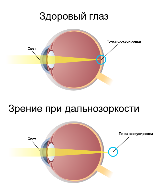 Глаукома это близорукость или дальнозоркость