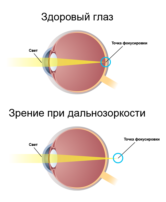 Дальнозоркость это заболевание сетчатки
