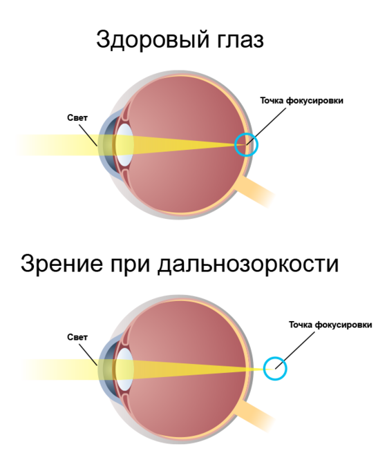 Дальнозоркость это заболевание сетчатки