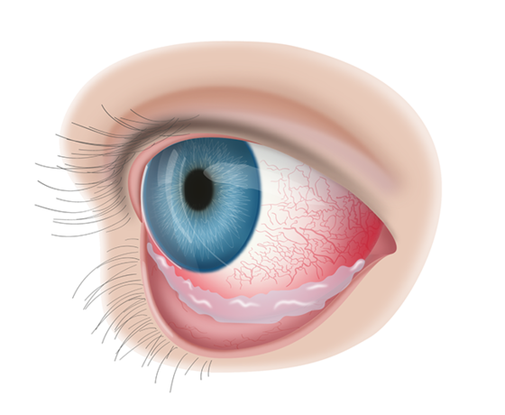 Лечение конъюнктивита глаз