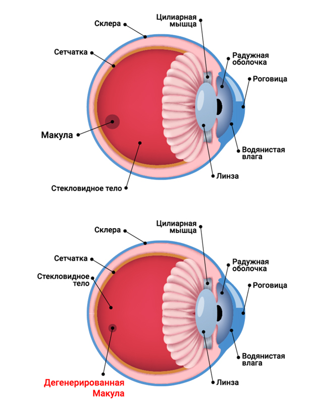 Задний полюс глаза. Дегенерация желтого пятна. Макулодистрофии сетчатки глаза что это такое. Дегенерация желтого пятна глаза. Возрастная дегенерация желтого пятна симптомы.