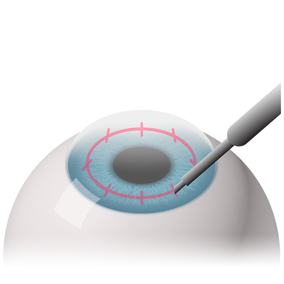 Глаукома это близорукость или дальнозоркость