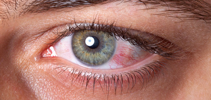Что стоит за кровоизлиянием под конъюктиву глаза?