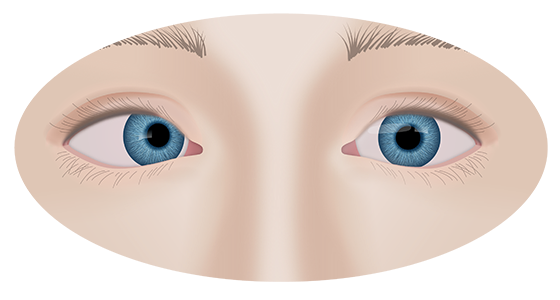 Диплопия глаза: причины, симптомы, лечение