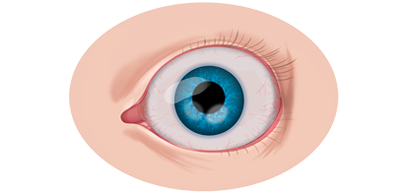 Эндокринная офтальмопатия (ЭОП)