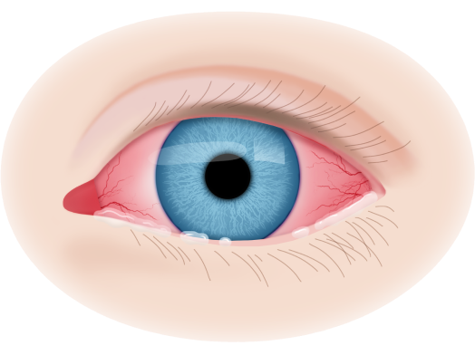 Воспаление роговицы глаза после линз