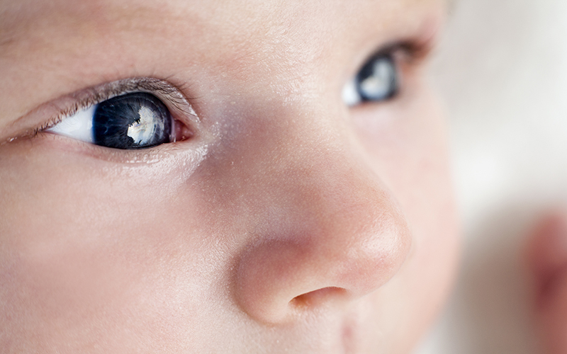 Новый способ оценки степени ретинопатии недоношенных детей