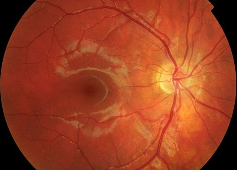 Болезни глаз связали с повышенным риском развития деменции