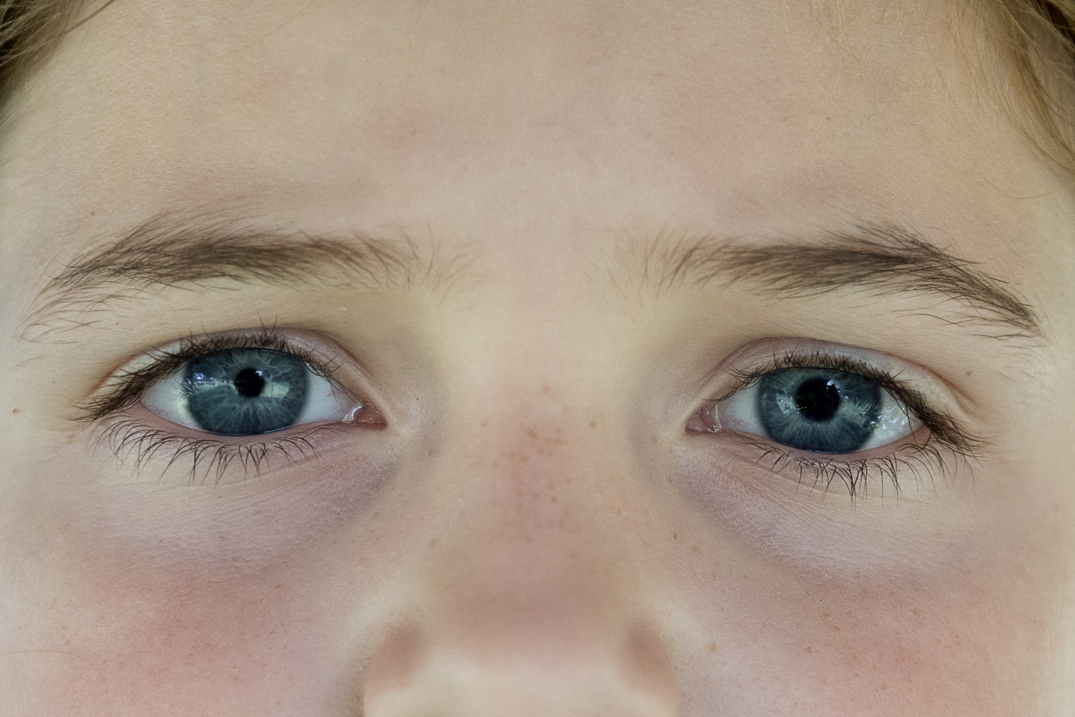Глазами есть причина по. Анизокория. Физиологическая анизокория. Анизокория врожденная.